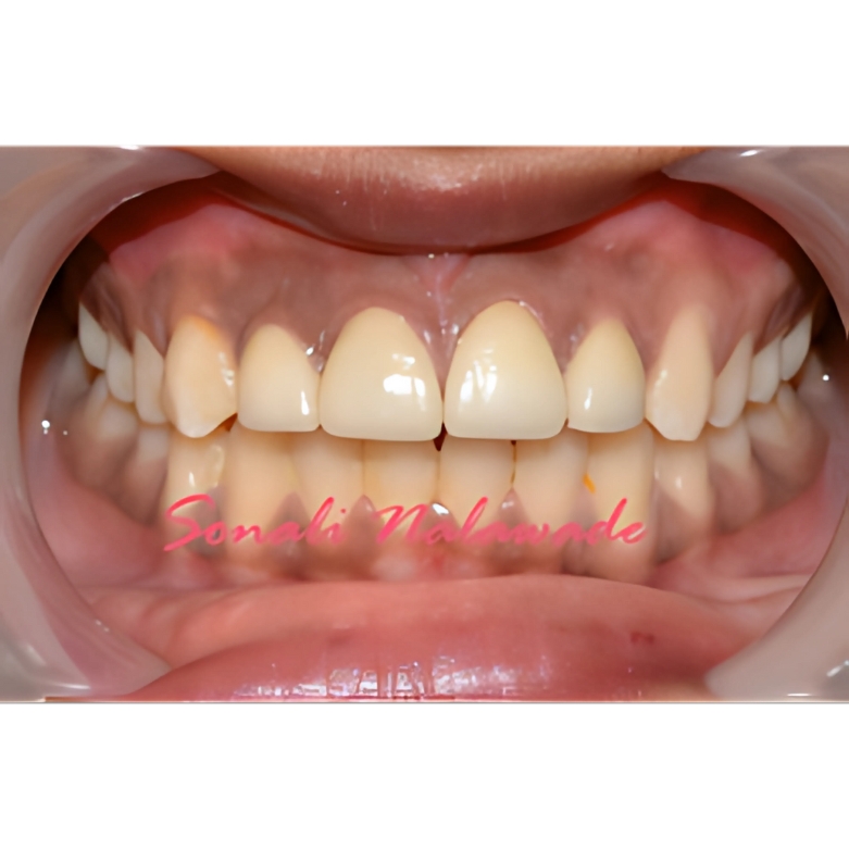 Root Canal Diagnosis in Nigdi & Akurdi – Advanced X-rays